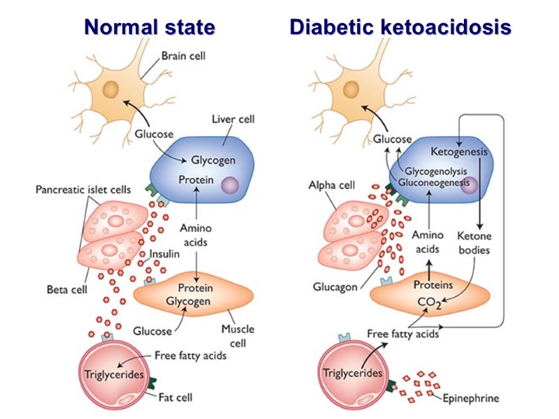 Normal state Diabetic ketoacidosis
